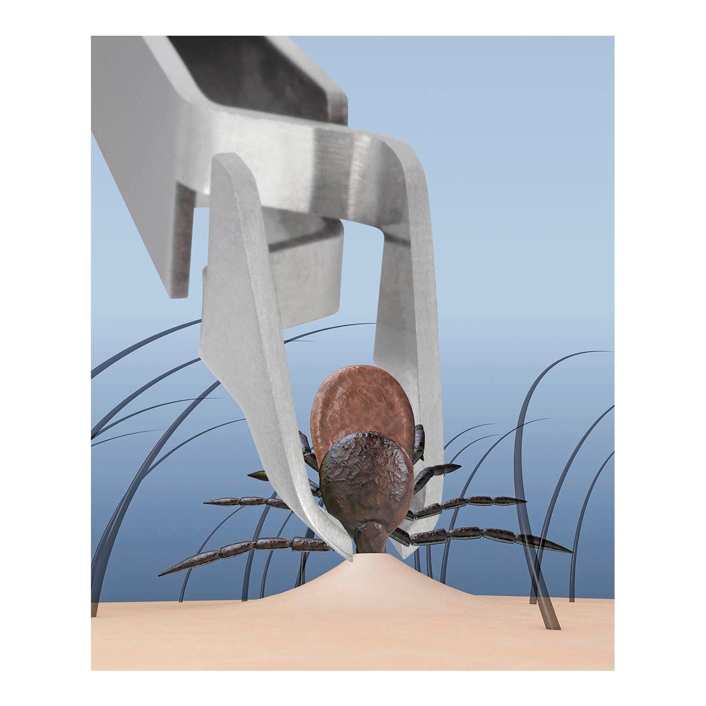 Quickex Zeckenzange mit Lupe und LED